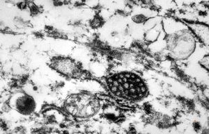 M,59y. | endothelial Weibel-Palade tubular body - angiomatous tumor, v.s.Kaposi M,59y. | endothelial Weibel-Palade tubular body - angiomatous tumor, v.s.Kaposi